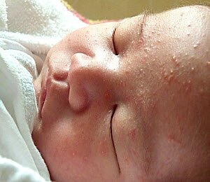 Прыщики на лице новорожденного - фото