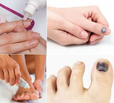 Ушиб ногтя на ноге народное лечение