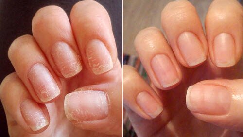 Как вылечить ногти после накладных ногтей